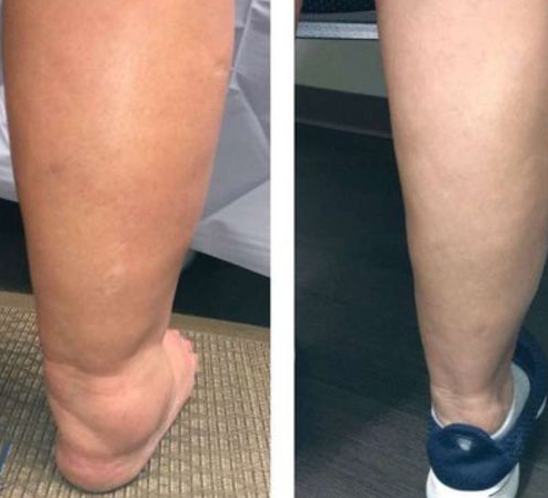 INGYENES SZÁLLÍTÁS AFIZ TURMALIN LYMPH KARCSÚSÍTÓ ORVOSI ZOKNI