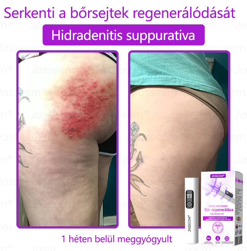 𝐉𝐚𝐬𝐬𝐞𝐞𝐦® Fejlett, nem invazív bőrjavító CO₂ lézeres toll 🎉 (Gyengéden eltávolítja a szemölcsöket, anyajegyeket, öregségi foltokat és bőrkinövéseket – fájdalom és gond nélkül!)