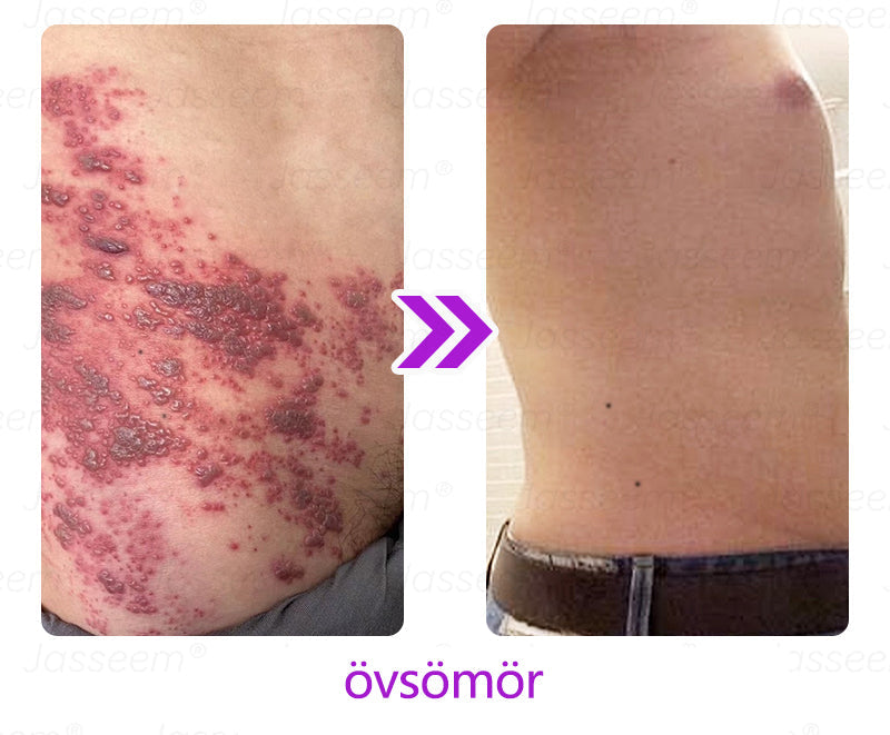 𝐉𝐚𝐬𝐬𝐞𝐞𝐦® Fejlett, nem invazív bőrjavító CO₂ lézeres toll 🎉 (Gyengéden eltávolítja a szemölcsöket, anyajegyeket, öregségi foltokat és bőrkinövéseket – fájdalom és gond nélkül!)