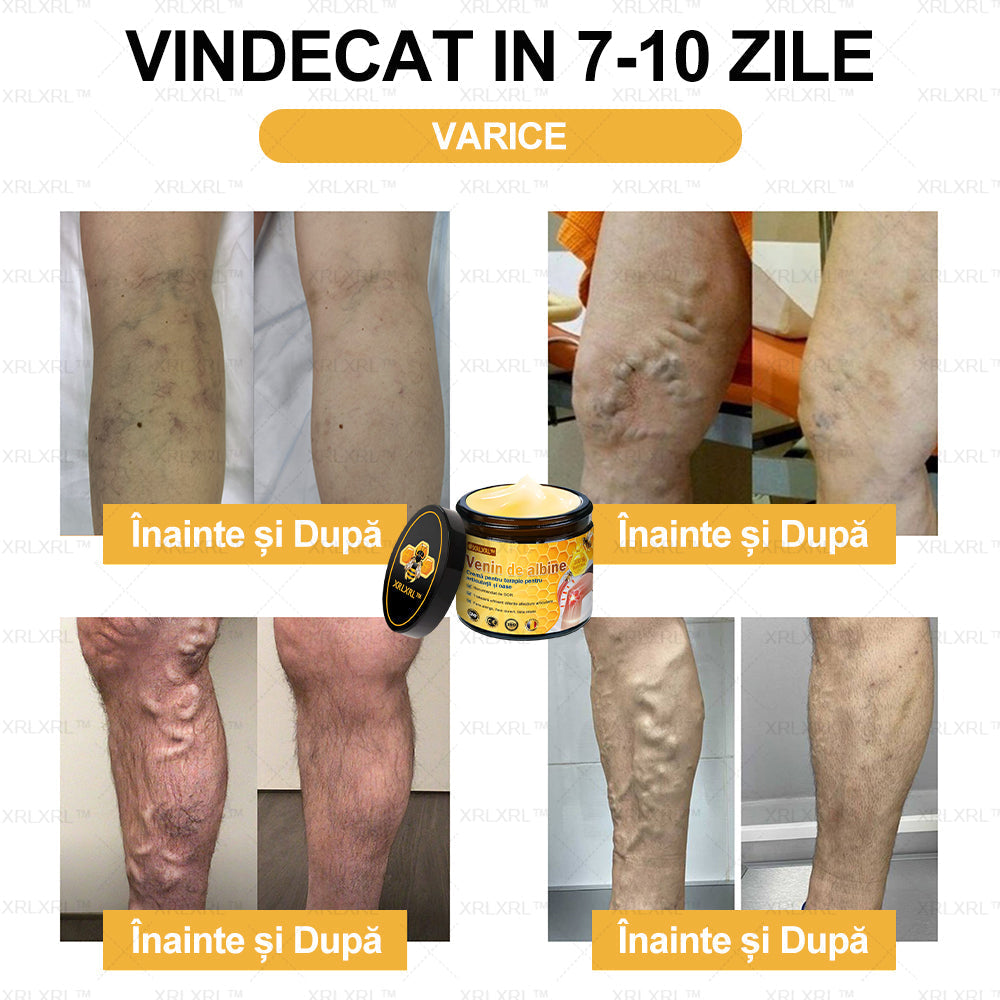 XRLXRL™ csontgyógyító méhméreg fájdalomcsillapító krém (kifejezetten idősebb felnőttek számára, az AAOS által ajánlott)